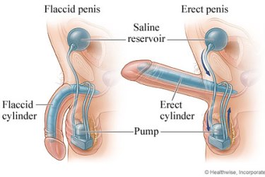 Penile Implant Surgery in India, Best Doctor for Penile Implant Surgery in India, Best Hospital for Penile Implant Surgery in India, Cost of Penile Implant Surgery in India, Dr Raman tanwar andrologist for penile implant surgery, dr gautam banga penile implant surgeon in india