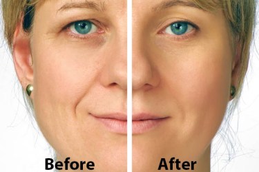 Blepharoplasty Surgery in India, Plastic Surgery for Sagging Eye Lid, Eye Lid Surgery in India, Best Plastic Surgeon in India, Cost of Eye Lid Surgery in India